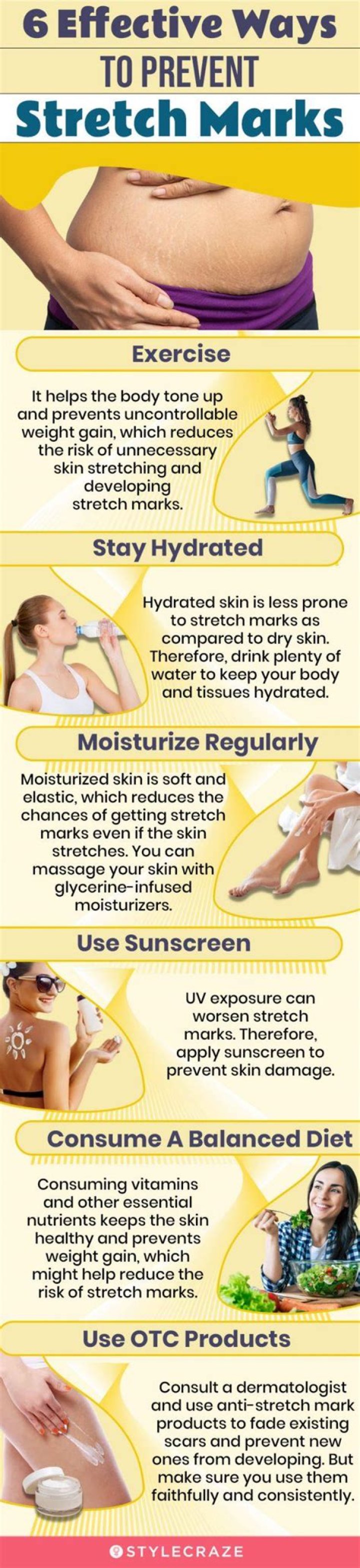 Is it possible to remove stretch marks?