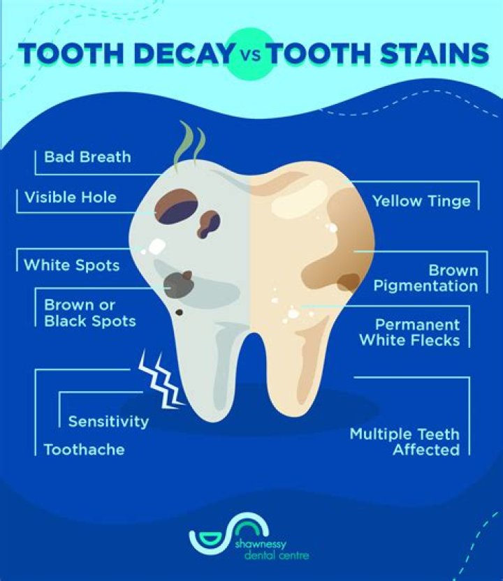 Is it tartar or my tooth?