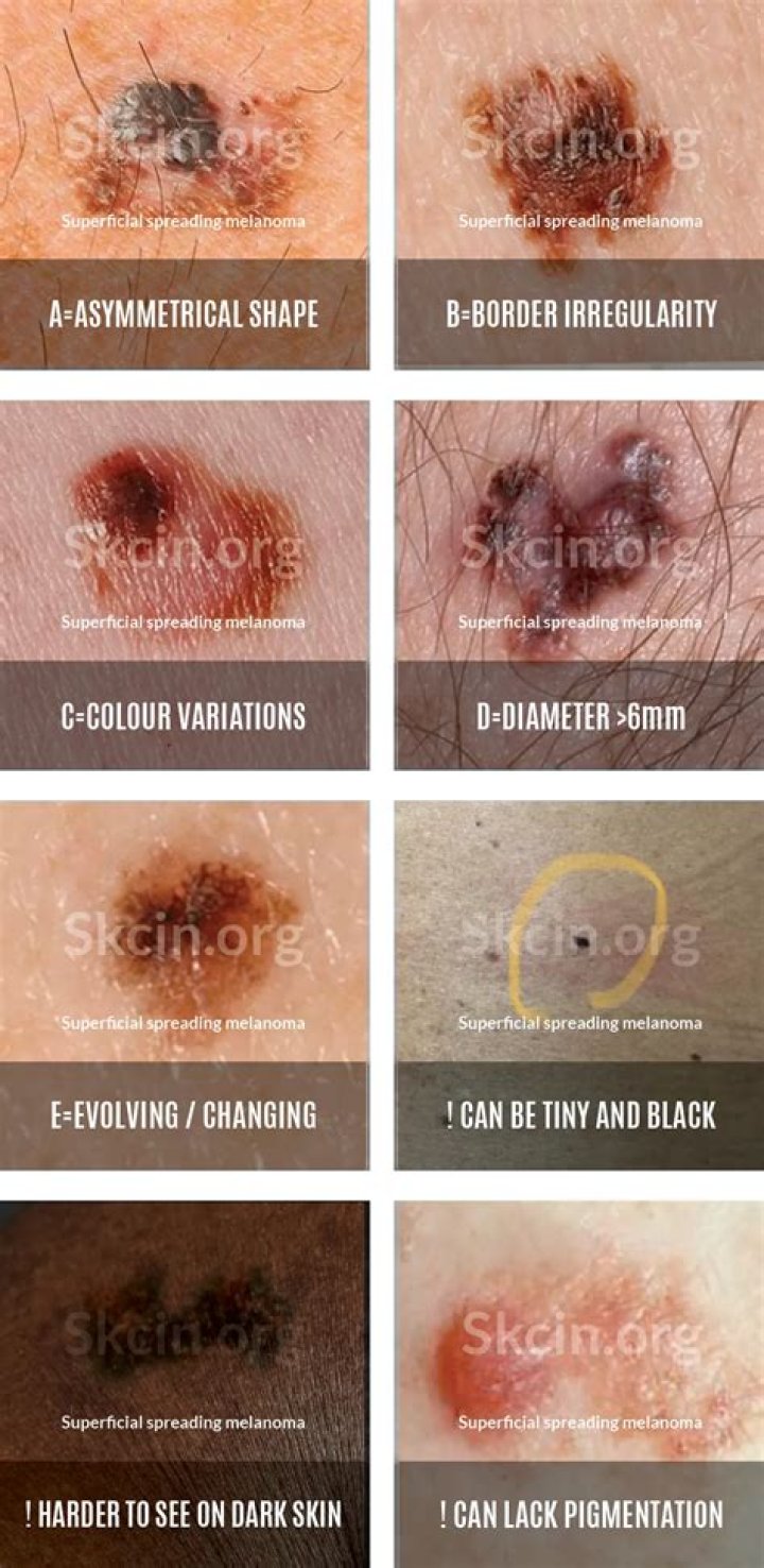 Is melanoma usually caught early?