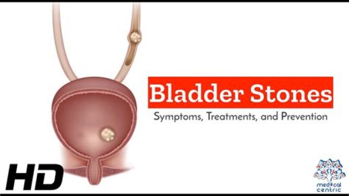 Is moringa good for bladder stones?