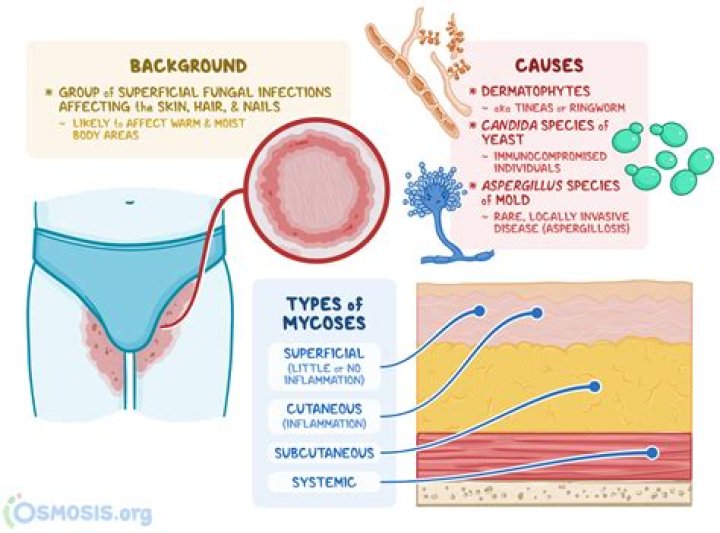 Is mycosis fungoides caused by a fungal infection?