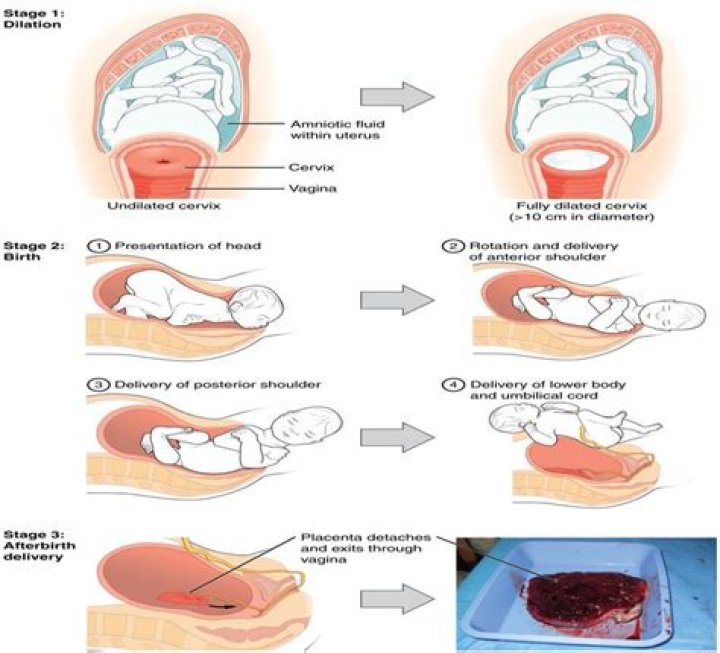 Is normal delivery possible with grade 3 placenta?