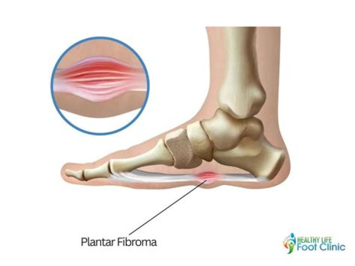 Is plantar fibroma the same as Ledderhose?