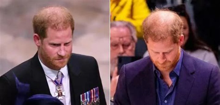 Is Prince Harry's hair thinning?