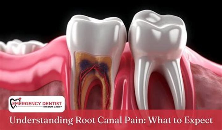 Is root canal painful?