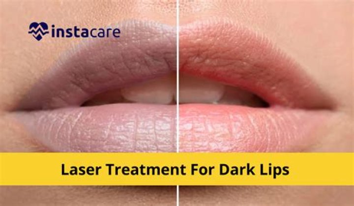 Is there laser treatment for dark lips?