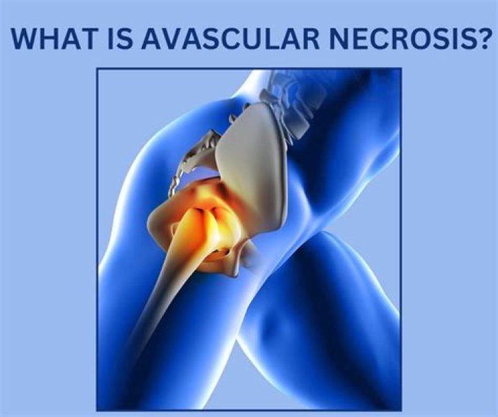 Is walking good for avascular necrosis?