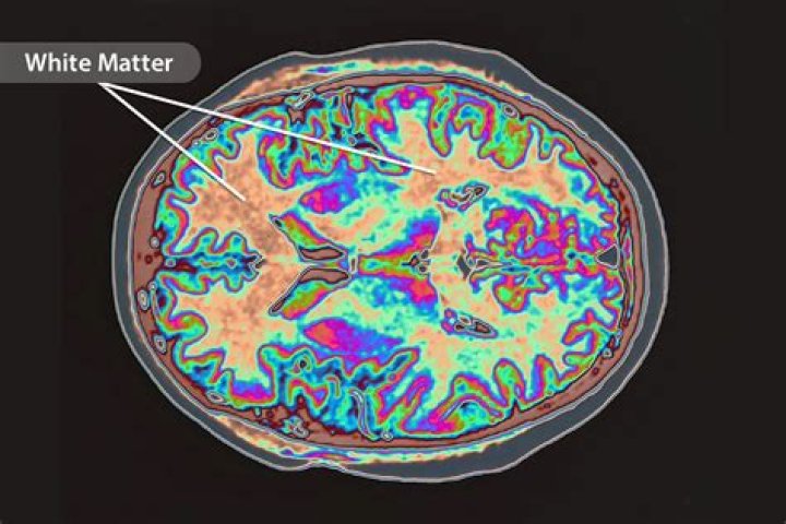 Is white matter disease the same as Alzheimer's?