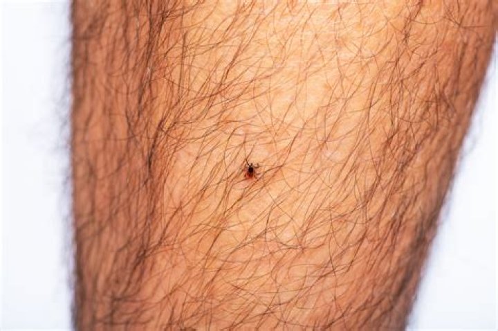 Should a tick bite hurt after removal?
