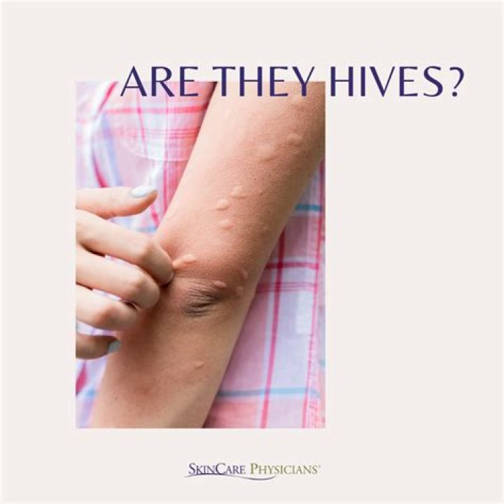 Should I go to the hospital if I have hives?