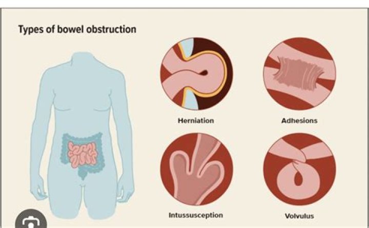 Should I take a stool softener if I have a bowel obstruction?