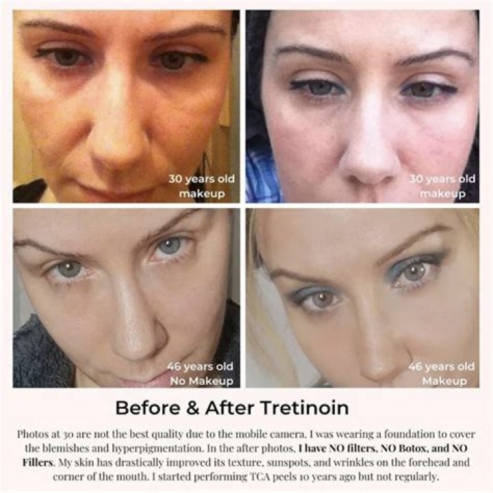 Should you let tretinoin dry before moisturizer?