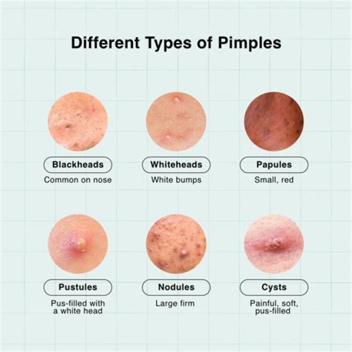 Should you pop purging pimples?
