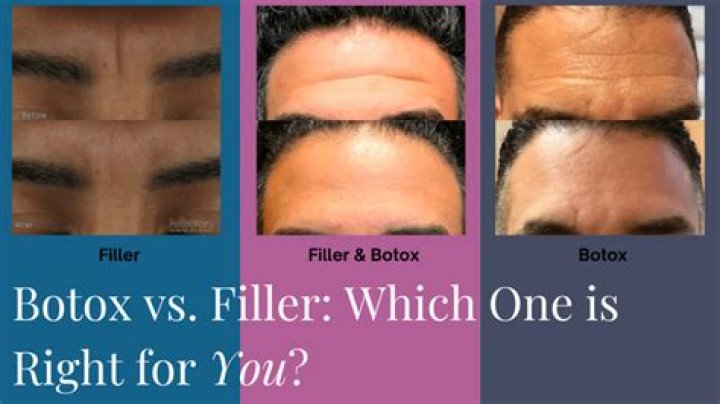 What's the difference between a filler and Botox?
