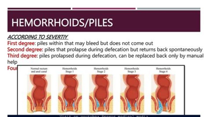 What are Stage 3 hemorrhoids?