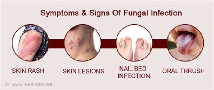 What are symptoms of fungus in the body?