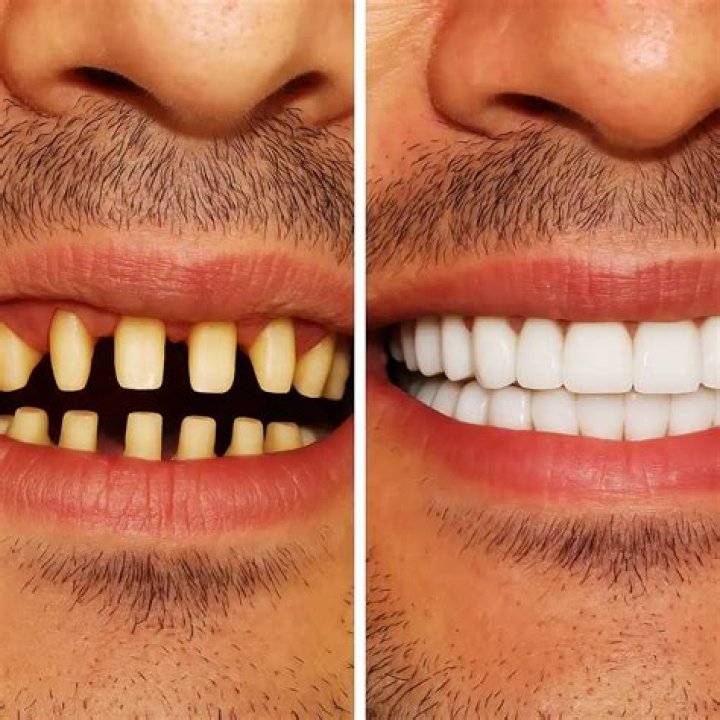 What are teeth Lumineers?