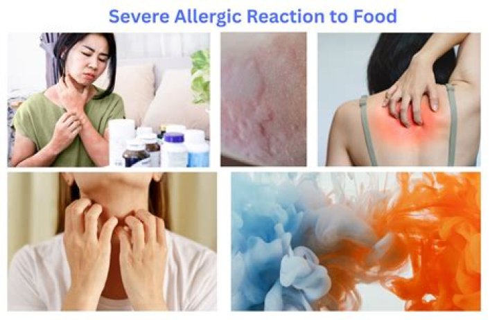 What are the 4 signs of a severe allergic reaction?