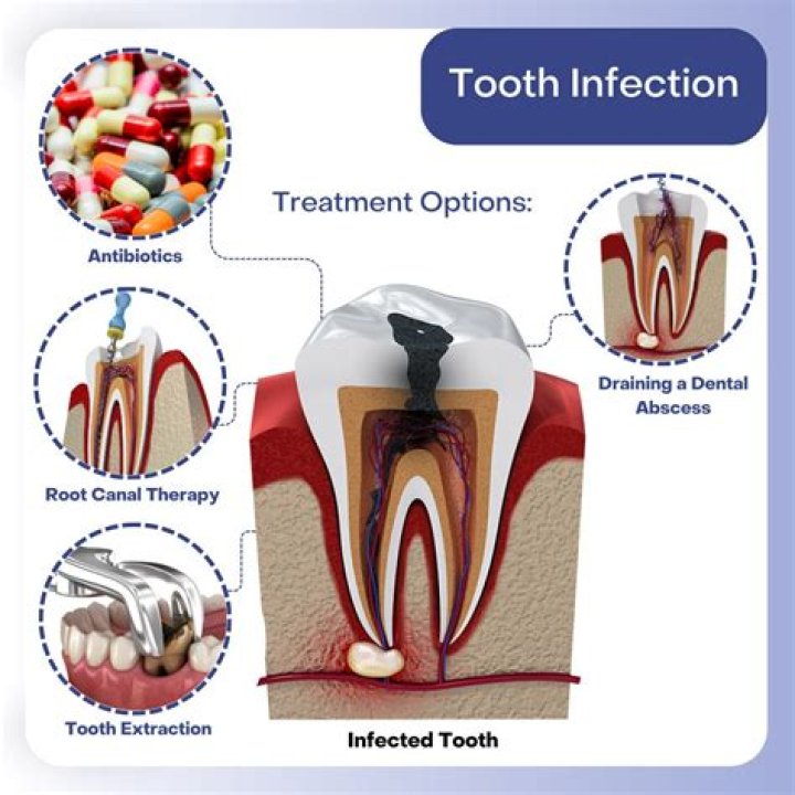 What are the chances of dying from a tooth infection?