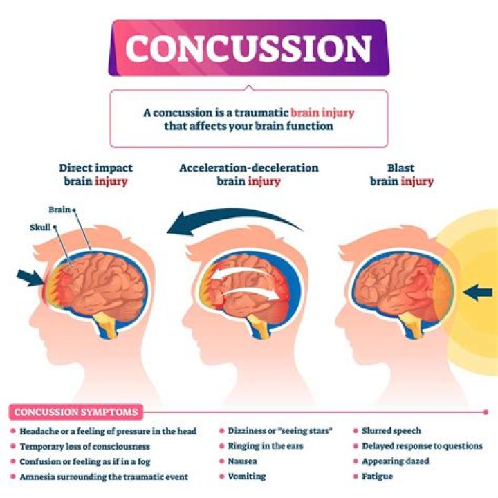 What are the signs of delayed concussion?