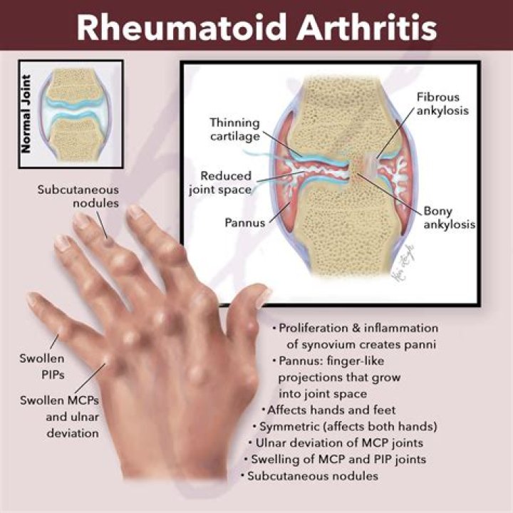 What blood work shows arthritis?