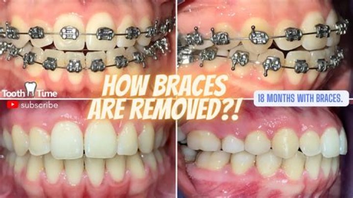 What can't you do with braces?