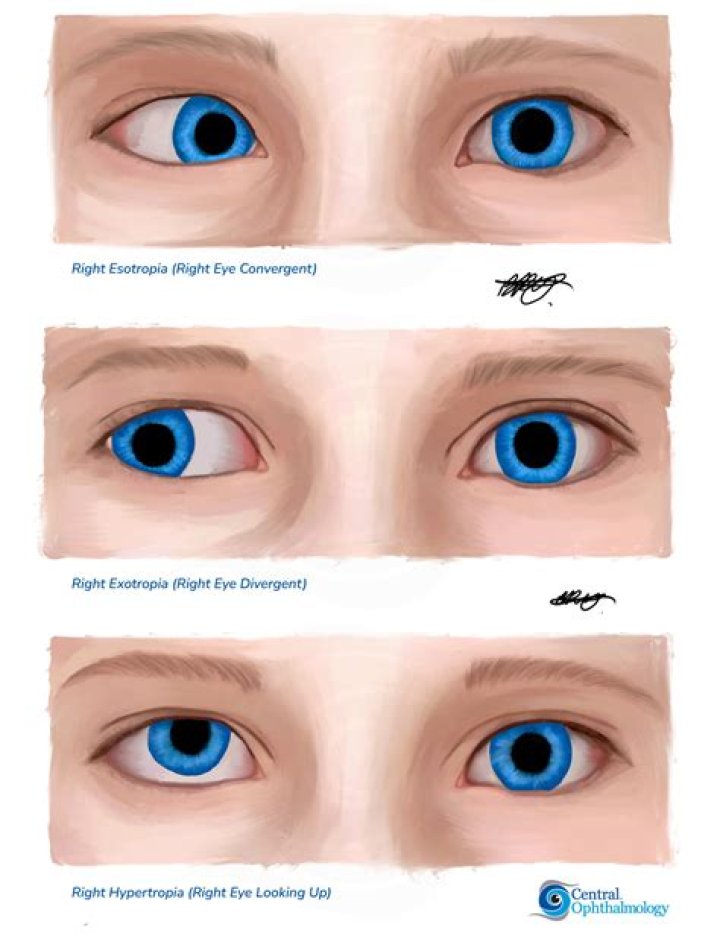 What can go wrong with strabismus surgery?