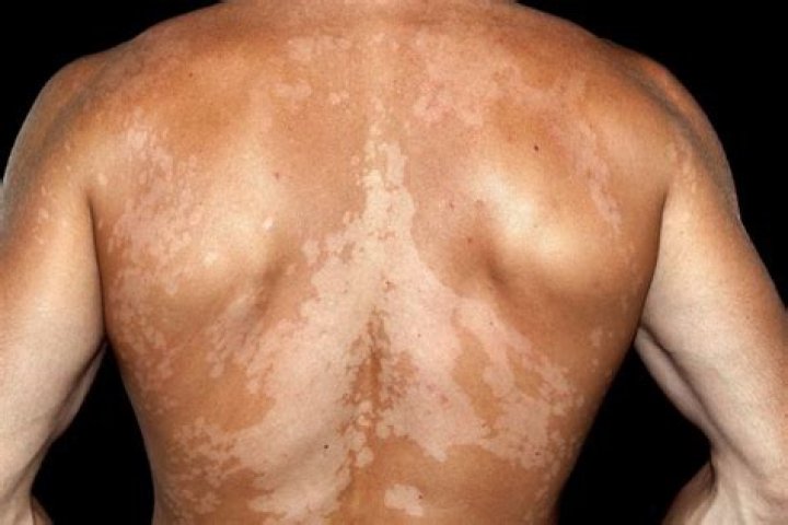 What causes discoloration of the skin?