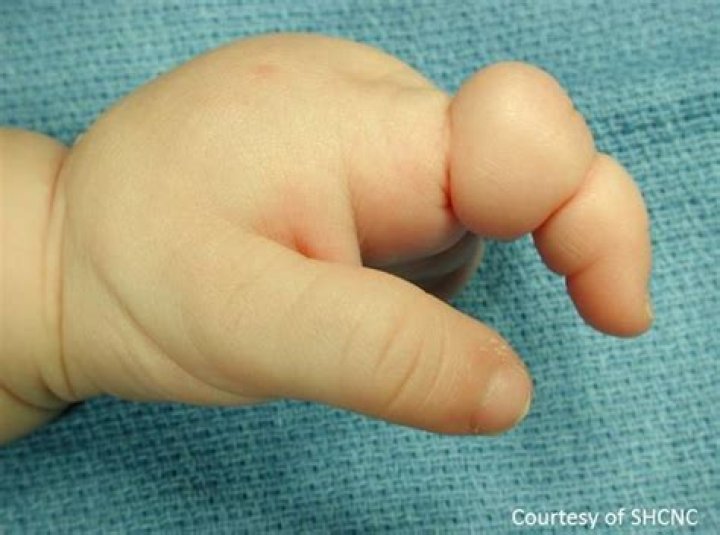 What causes missing fingers at birth?