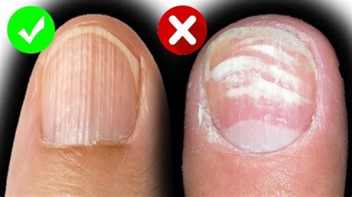 What causes ripples in toenails?