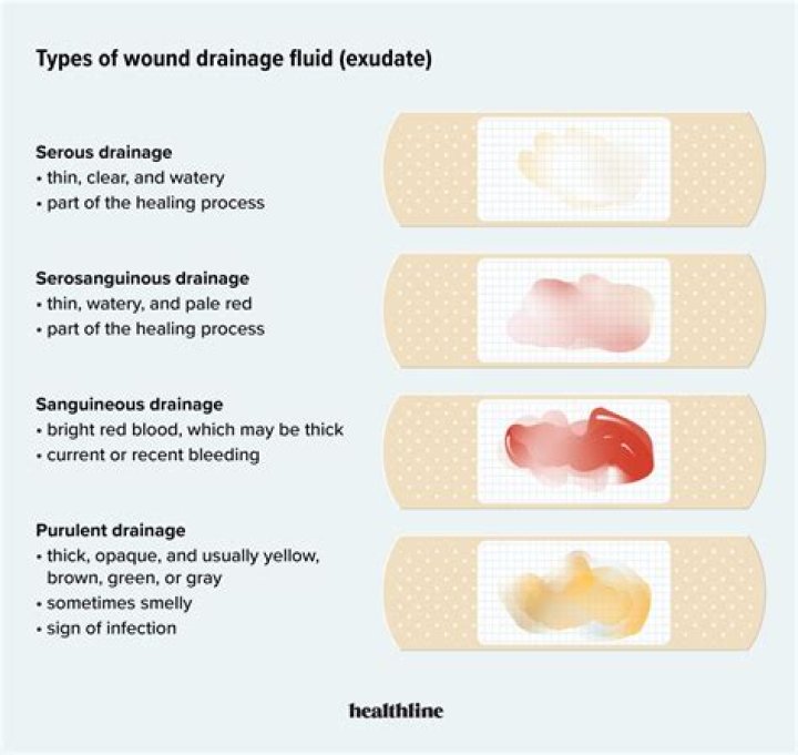 What color is Serosanguineous drainage?
