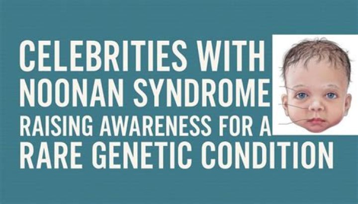 What do babies with Noonan syndrome look like?
