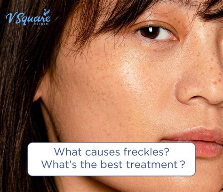 What do freckles mean?