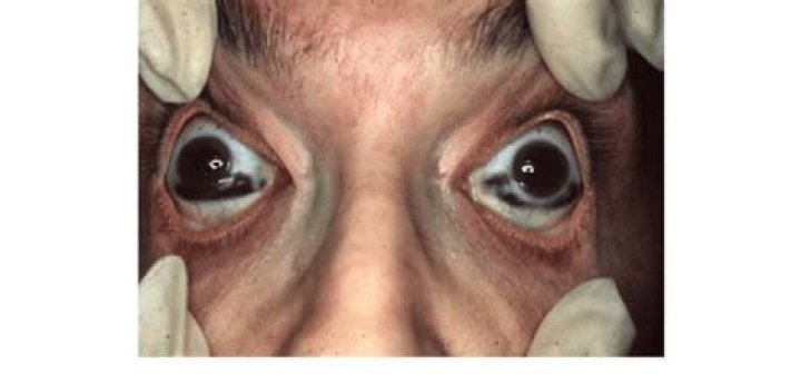 What do the eyes of a dying person look like?