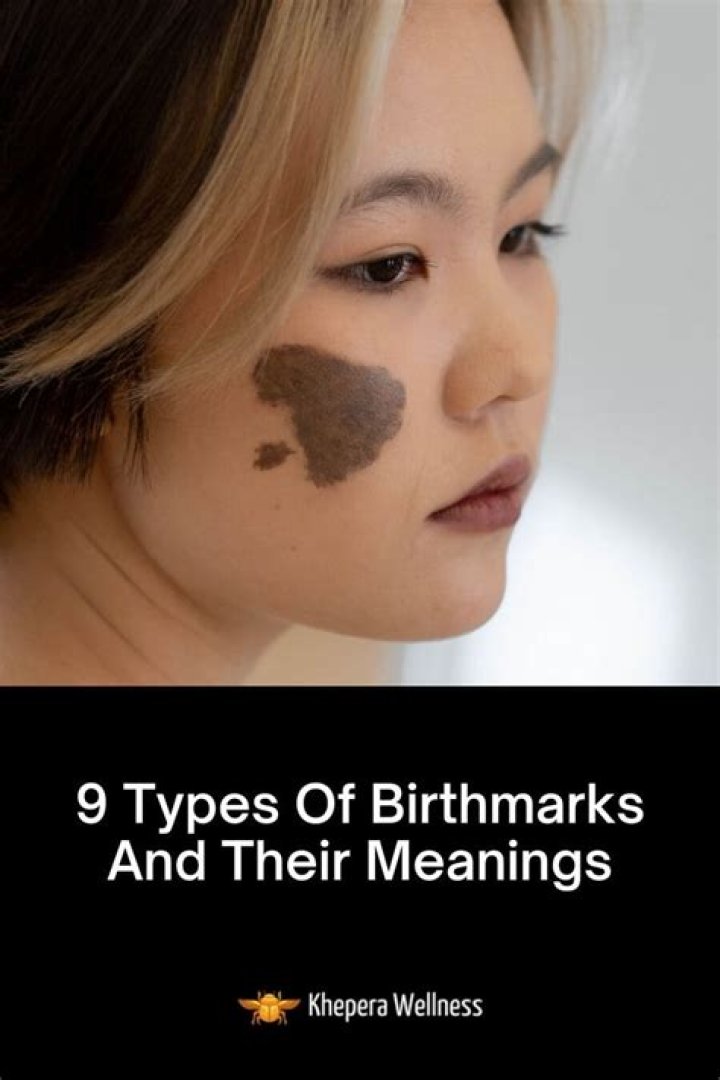 What do white birthmarks mean?