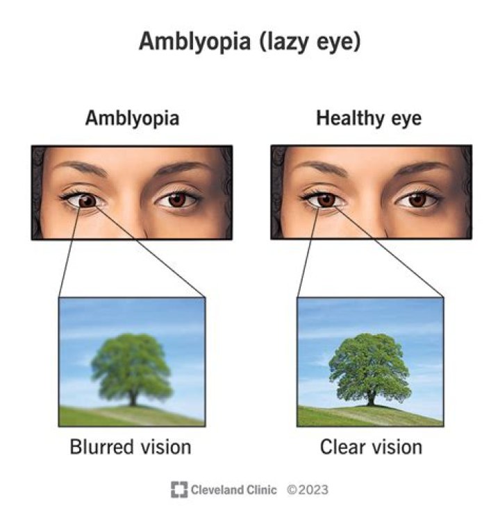 What does a person with amblyopia see?