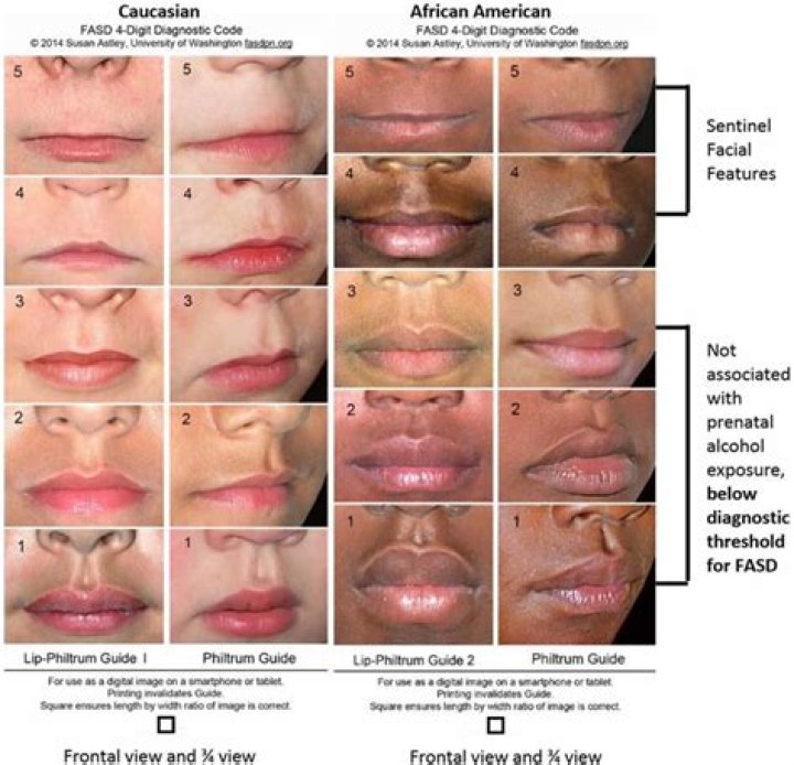 What does a smooth philtrum mean?