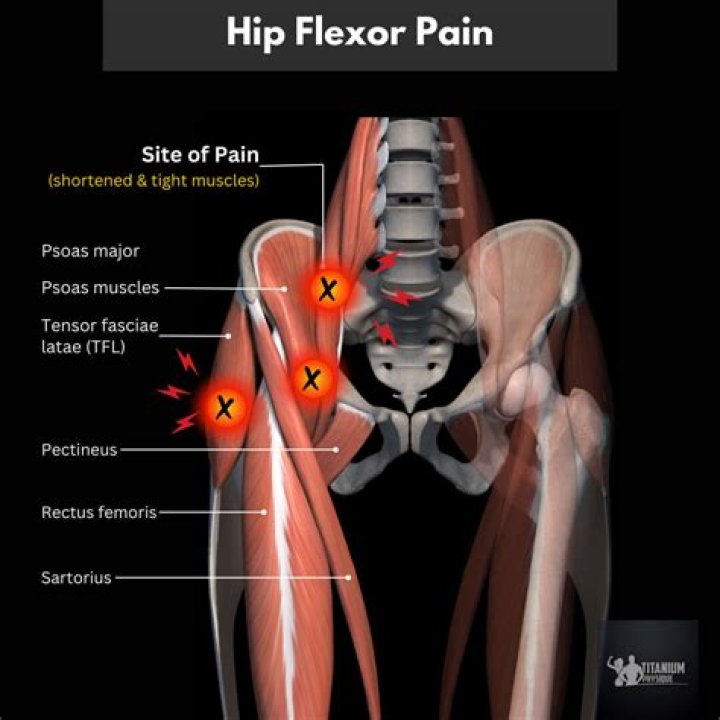 What does a torn hip flexor feel like?