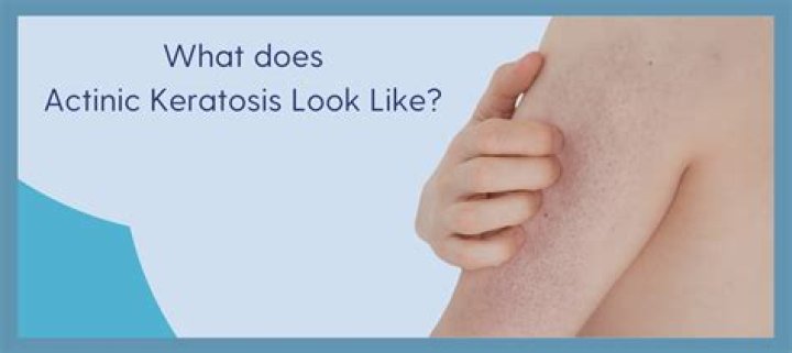 What does actinic keratosis look like?