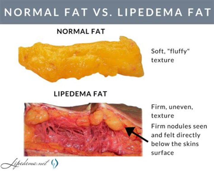 What does fat feel like under the skin?