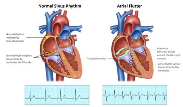 What does it mean when your heart flutters and you cough?