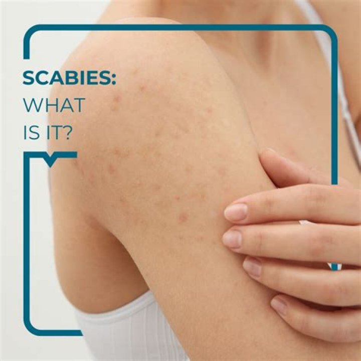 What does scabies feel like at first?