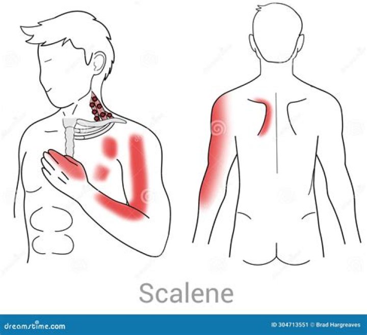 What does scalene pain feel like?