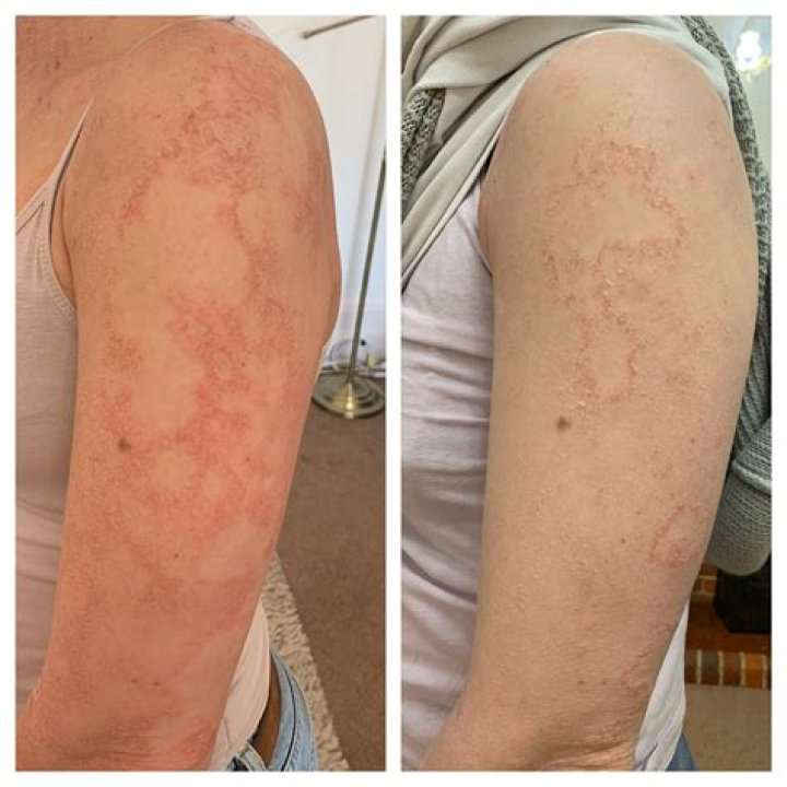 What does skin fungus look like?