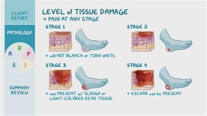 What does Winston's ulcer symbolize?
