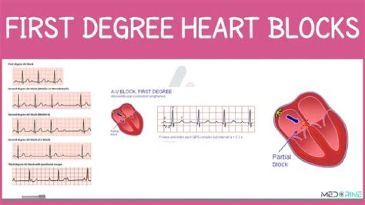 What drugs can cause first degree heart block?
