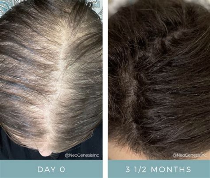 What happens if hair doesn't grow back after chemo?
