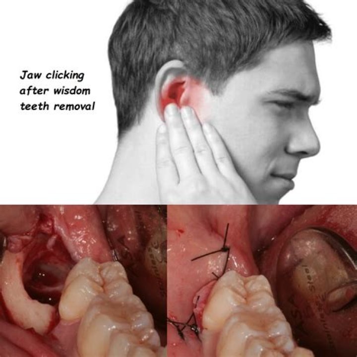 What happens if you accidentally drank out of a straw after wisdom teeth?