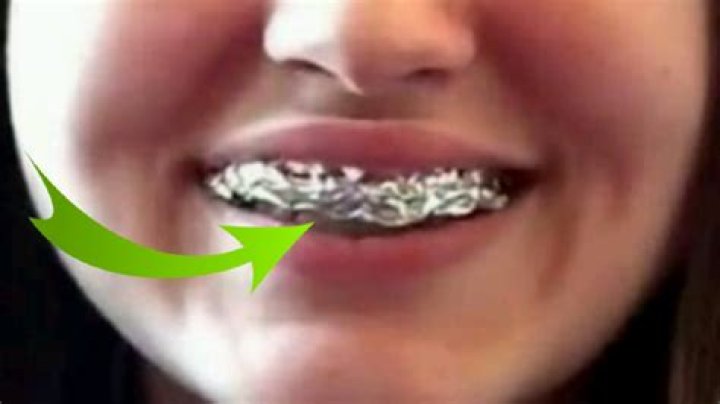 What happens if you put foil on your teeth?