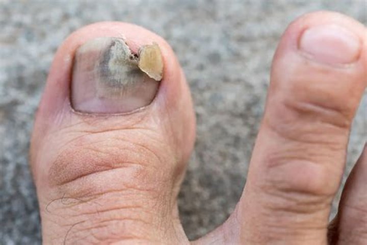 What is a unicorn toenail?